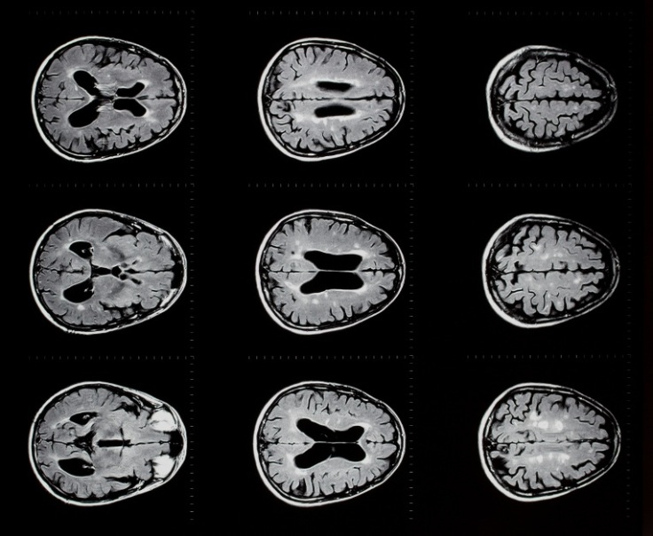 An MRI scan of a brain